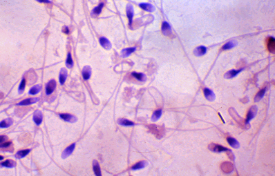 全球男性精子濃度在過去40年下降超過50%,專家警告人類生殖能力正在下降。(翻攝維基百科/人類精子HE染色光鏡圖)