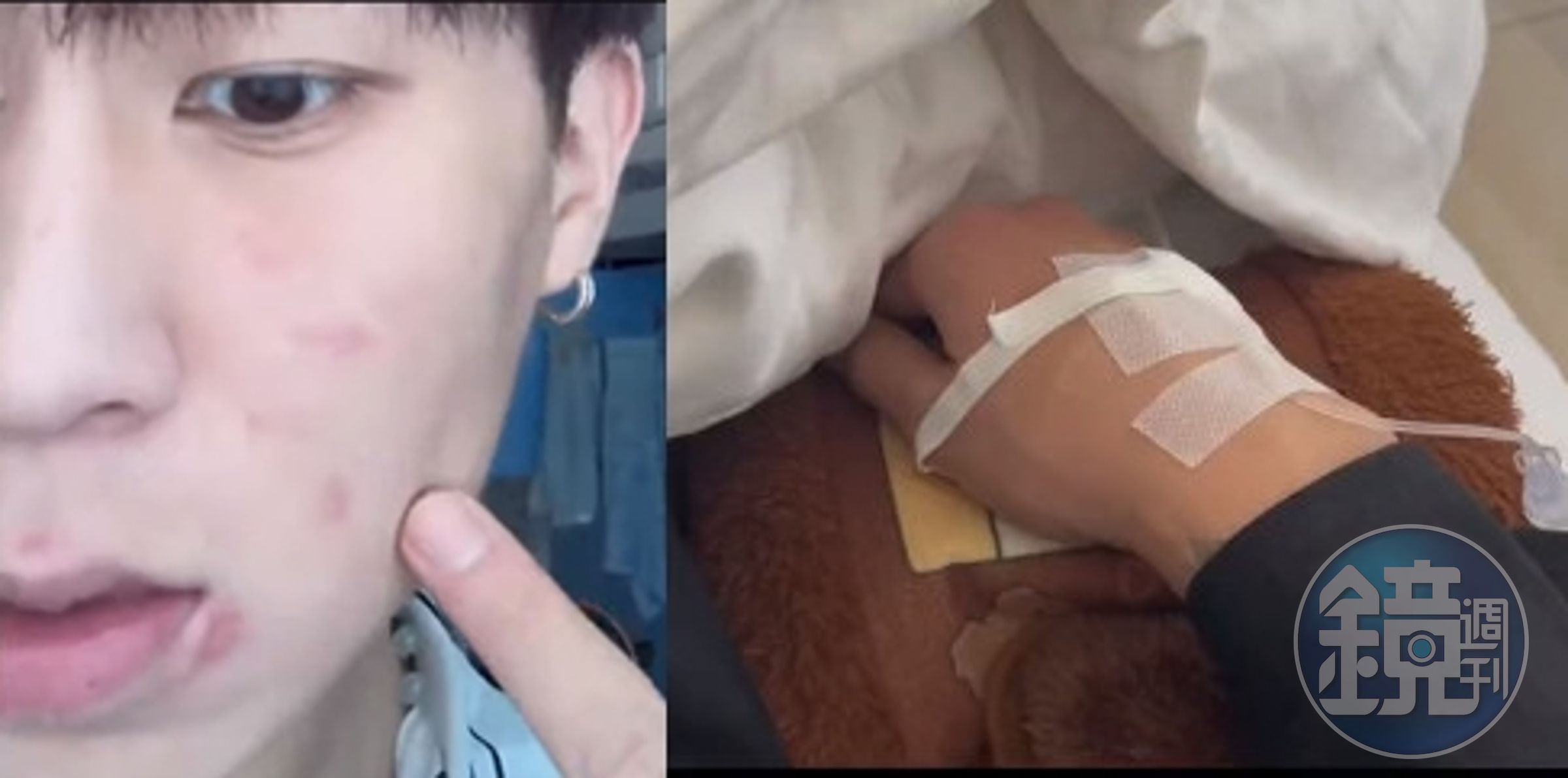 小博動手清理室友發霉床鋪，反而因為太髒而過敏長痘痘，去醫院打點滴。（翻攝抖音）
