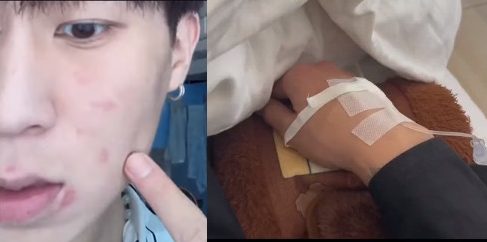 小博動手清理室友發霉床鋪，反而因為太髒而過敏長痘痘，去醫院打點滴。（翻攝抖音）