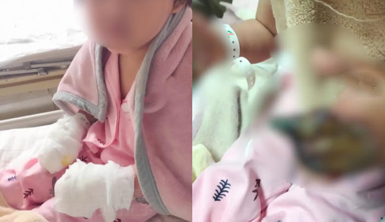 中國重慶一名小女孩因不慎將不鏽鋼筷子插進插座，導致雙手被電擊，兩手被層層紗布裹住。（翻攝微博@觀察者網）