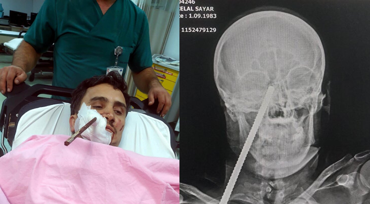 一名土耳其建築工人，在建築工地工作時不慎跌倒，遭一根鋼筋刺進右臉頰。（翻攝推特）