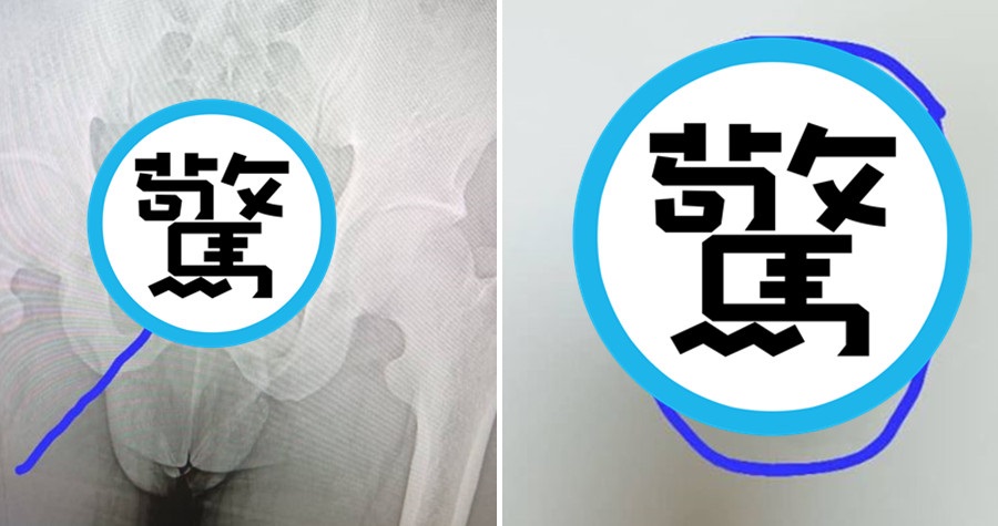 該名礦工將81克的黃金吞下肚，卻慘遭抓包。（翻攝@MINES_CD推特）