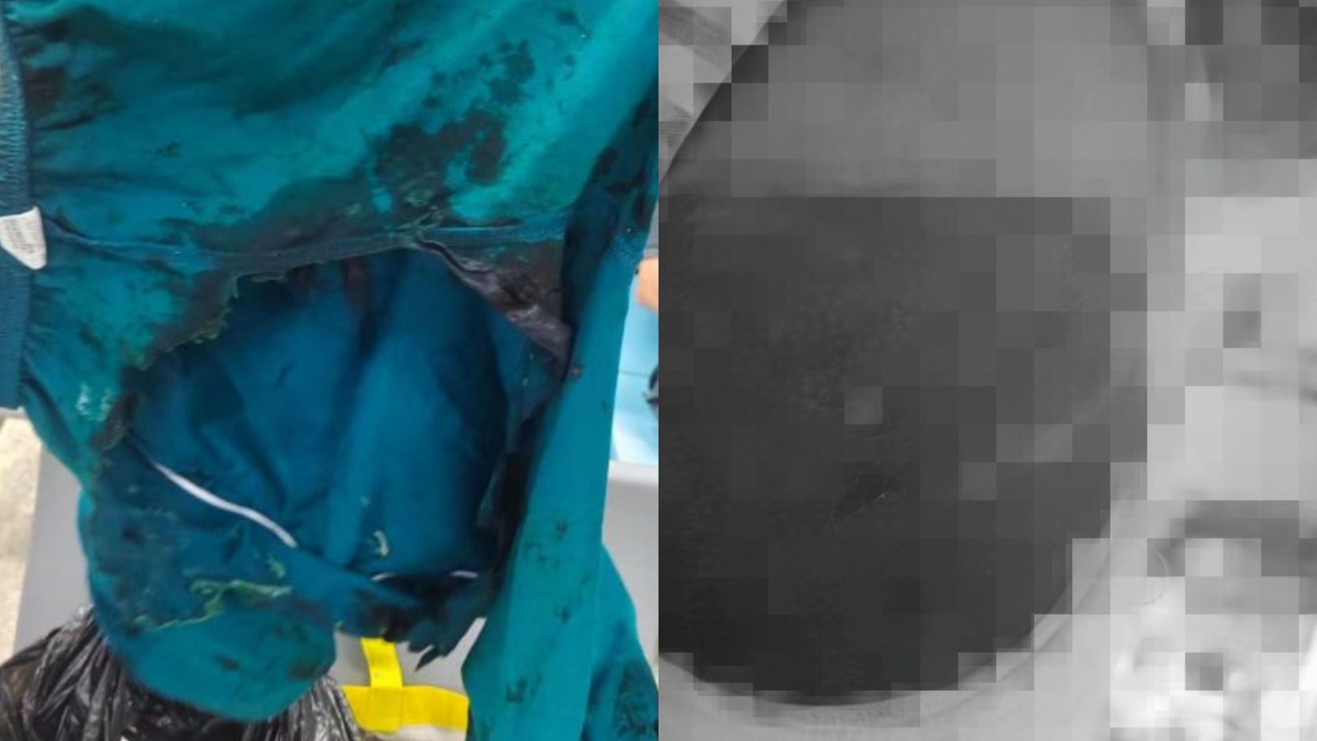 一名13歲少年在地鐵踩到「硫酸」滑倒，褲子破了大洞，屁股還嚴重灼傷。（翻攝紅星新聞）