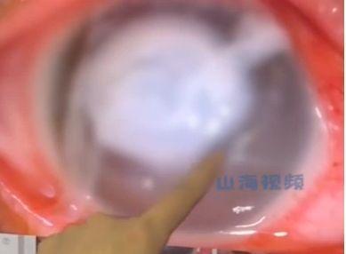 男子新婚夜忘摘隱形致角膜嚴重感染,險些失明。(翻攝自山海視頻)