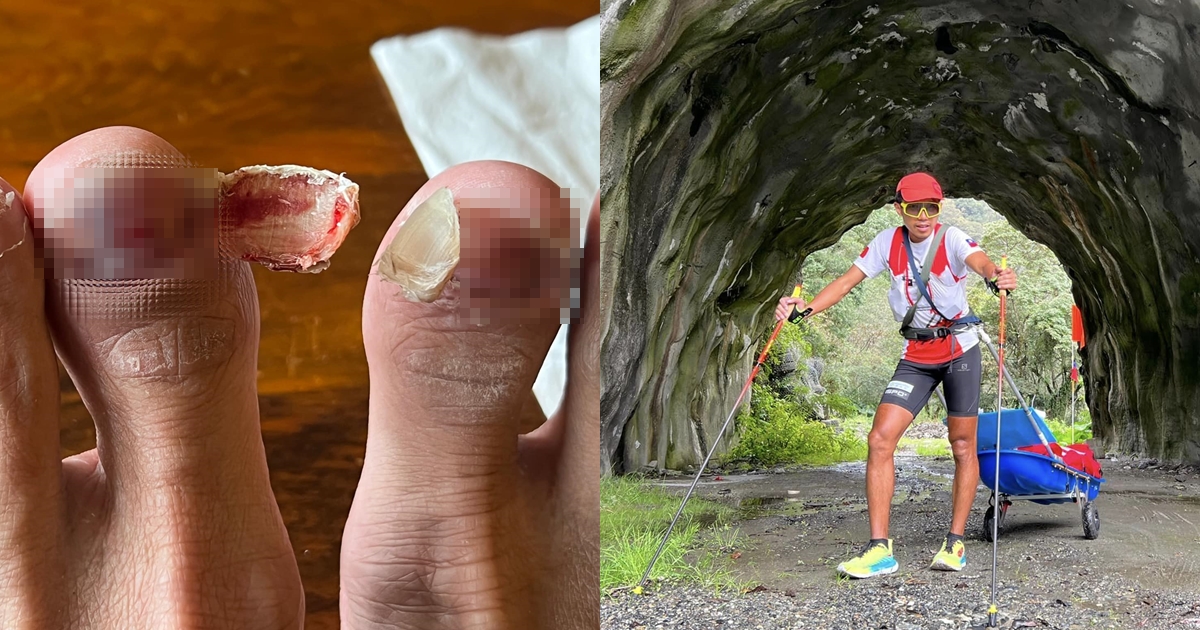 陳彥博在台灣備戰明年2月的極地超馬賽事，跑完半個台灣+武嶺的他，5片腳指甲整個脫落。（翻攝自陳彥博臉書）