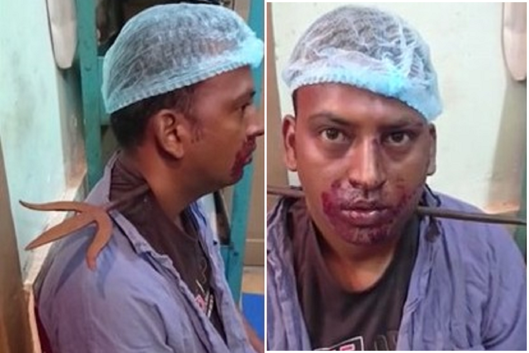 男被46公分三叉戟插穿頸部，未爆血還能正常說話太狂啦。（翻自《每日郵報》）