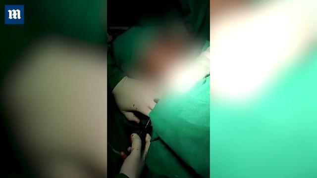 醫師花了一個半小時手術，成功將三叉戟取出。（翻自《每日郵報》）