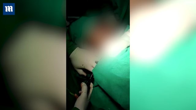 醫師花了一個半小時手術,成功將三叉戟取出。(翻自《每日郵報》)