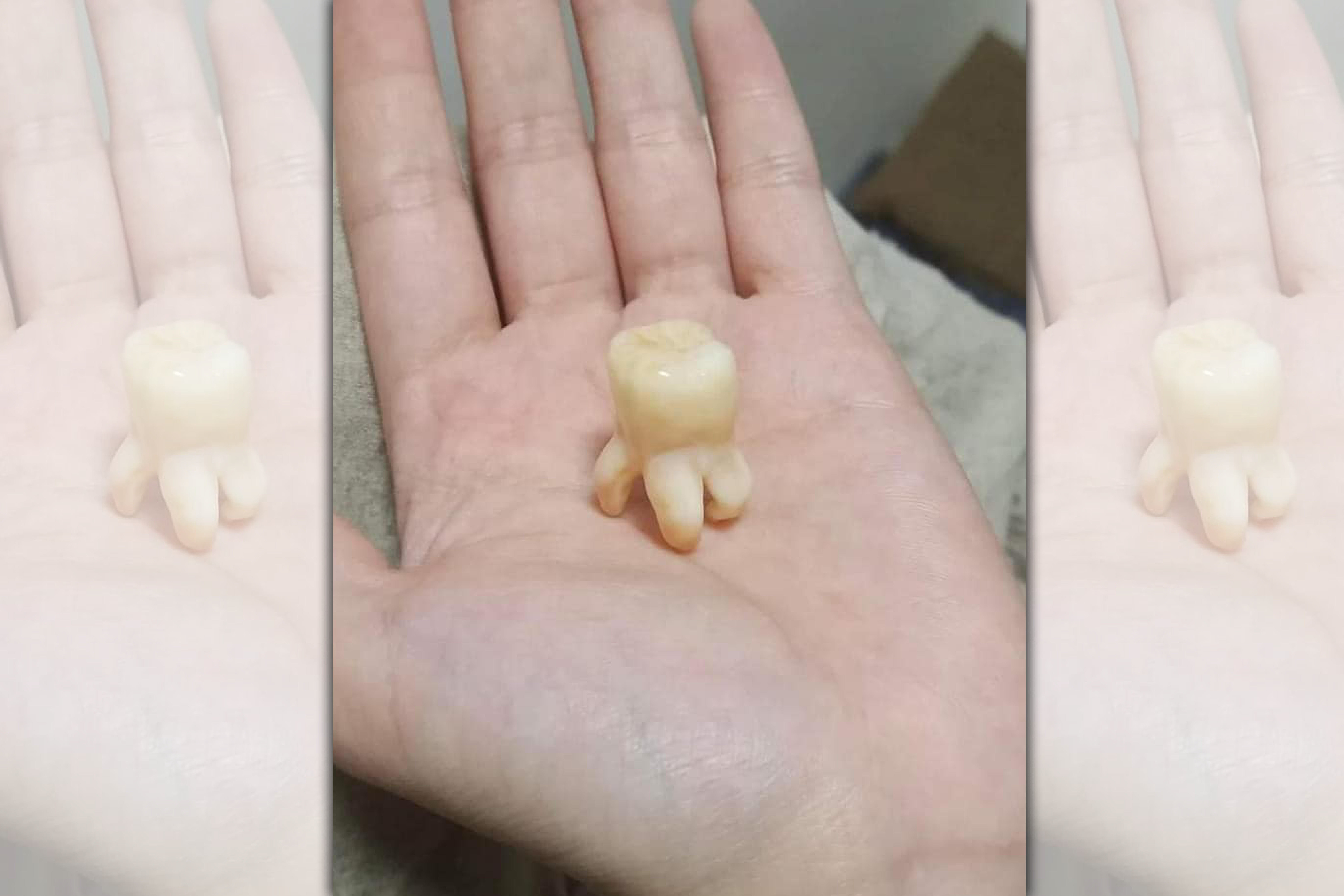  一名網友分享智齒照片，因為很大顆，形狀跟章魚相像而引起網友熱議。（翻攝自爆廢公社二館）