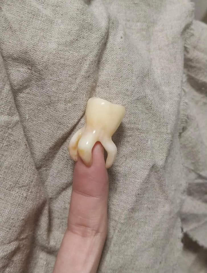 網友將智齒套在食指上，看起來像是被爪子抓住。（翻攝自爆廢公社二館）
