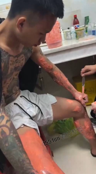 皇古身上有大面積燒傷。(翻自《黑料不打烊》)
