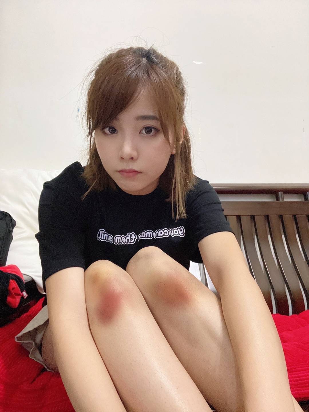 王上菲拍打戲滿腿都是瘀青。（經紀人提供）