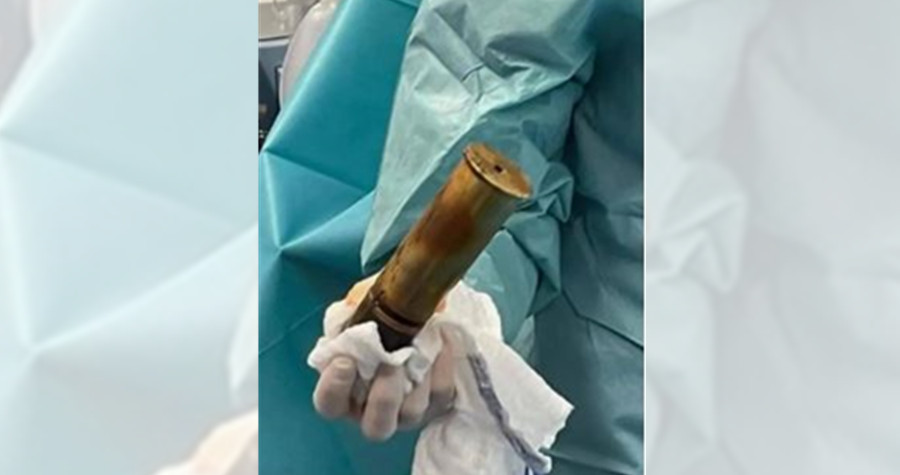 88歲阿公體內竟有一顆一戰未爆彈。（翻攝推特@acommonlawyer）