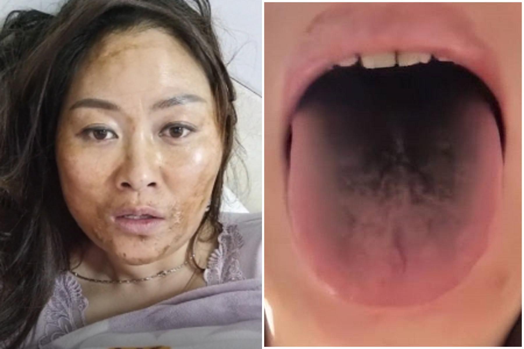 上海醫院悲壯公告「迎慘烈戰鬥」！中國染疫者出現恐怖黑臉黑舌，新變種病毒恐誕生。（翻自微博）