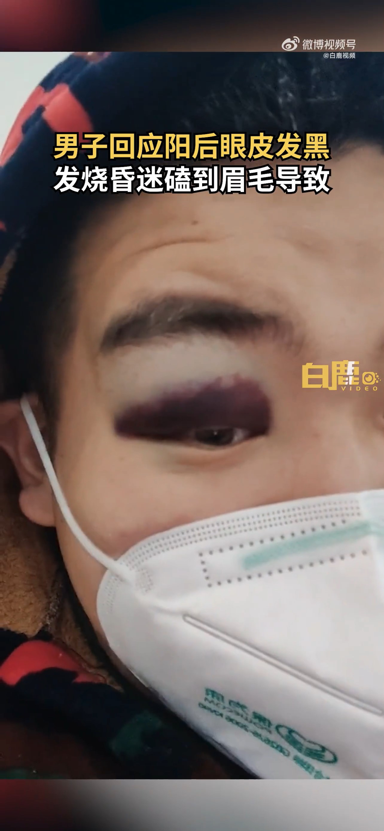 四川這名男子染疫後，眼皮竟然變黑。（翻自微博）