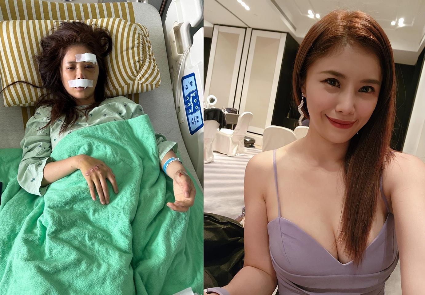 美女主播出了嚴重車禍,造成腦震盪、臉骨斷了3處,但她目前正逐步恢復中。(翻攝自宋燕旻臉書)