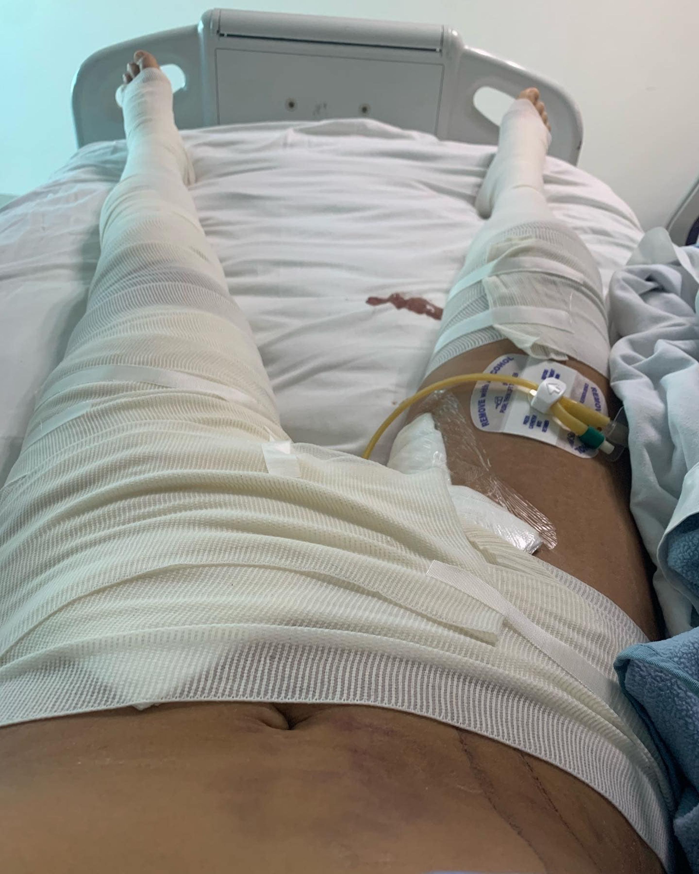 艾米蒂奇下體、腹部被螺旋槳切開,緊急動手術搶救後,傷口包滿紗布。(翻攝臉書「Amor Armitage」)