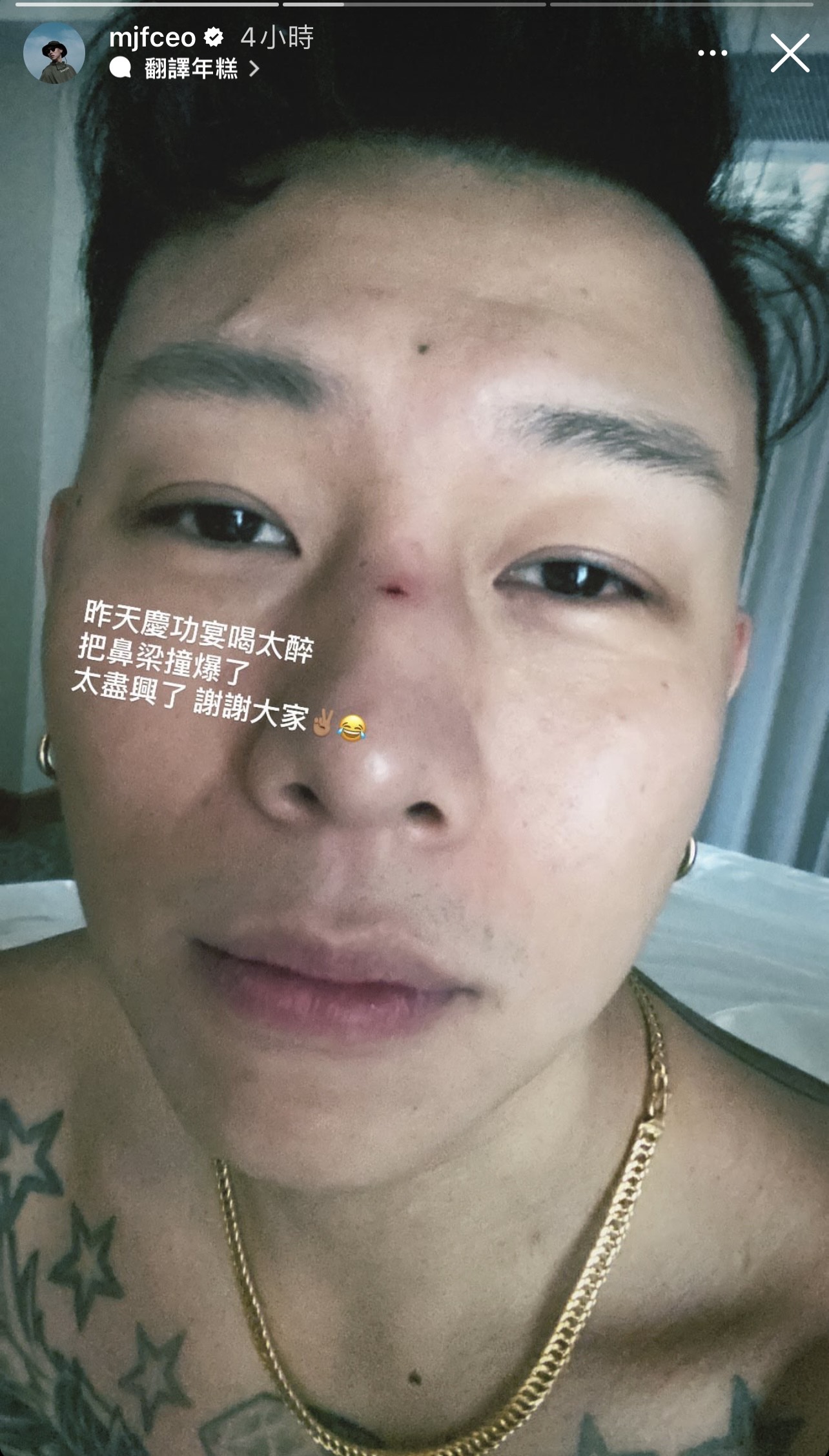 瘦子慶功喝太醉，撞傷破相。（翻攝自瘦子IG)