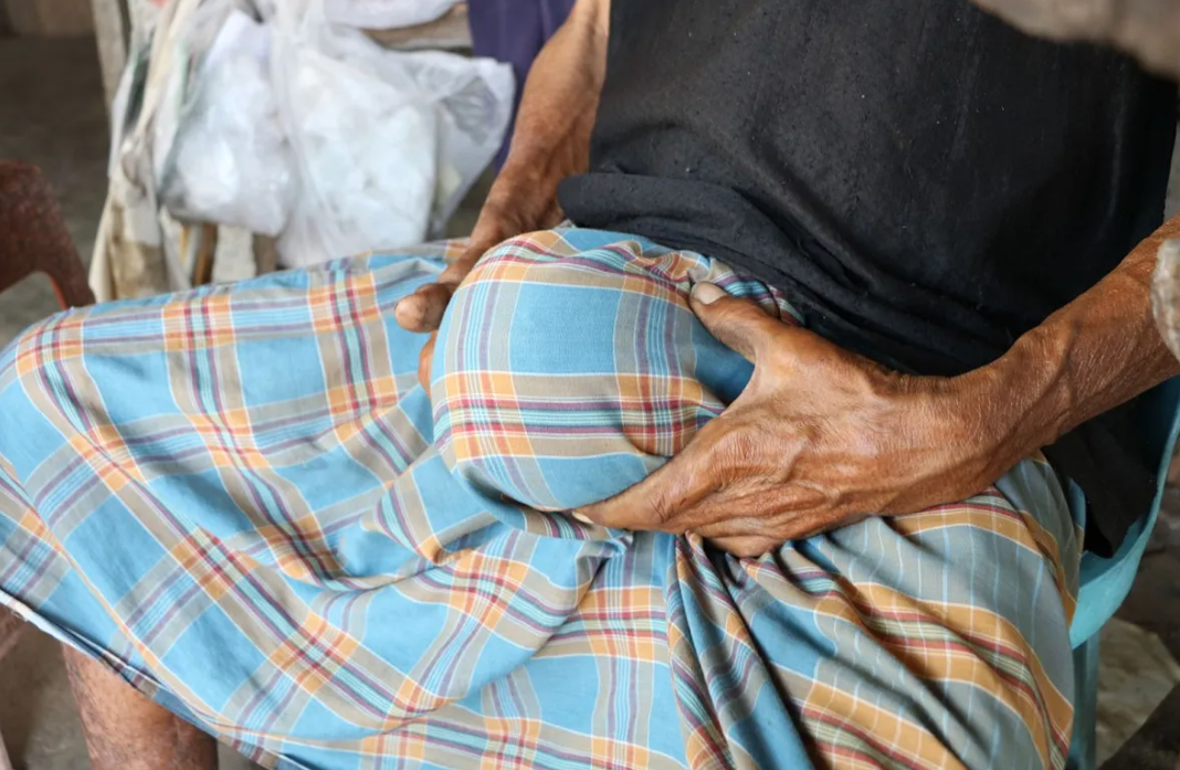 這不是九陽神功！他的睪丸腫如椰子，背後故事令人心酸。（翻自《Sanook》）