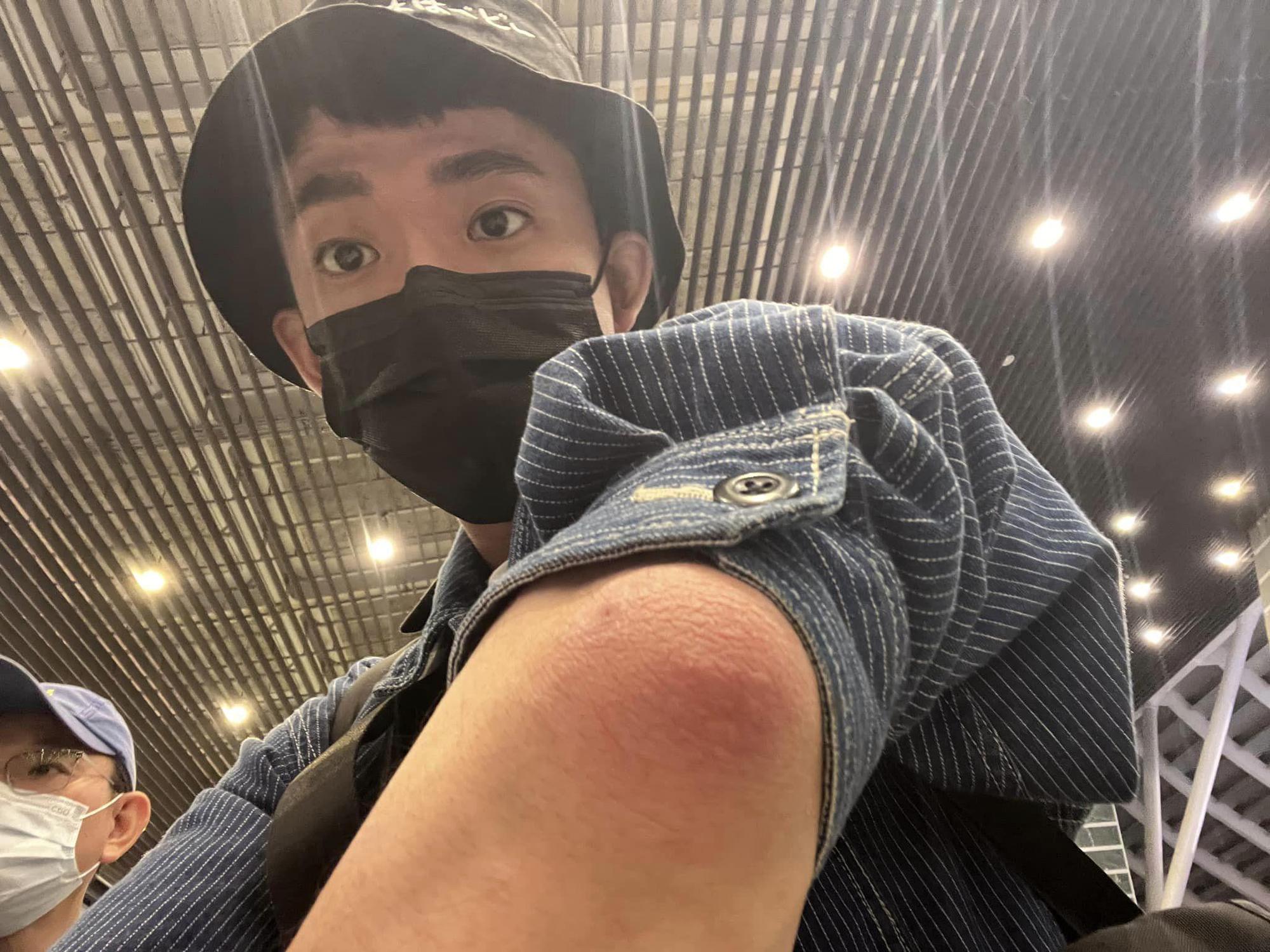 阿滴手肘腫起來,去看醫生結果研判可能是痛風發作。(翻攝自阿滴英文臉書)