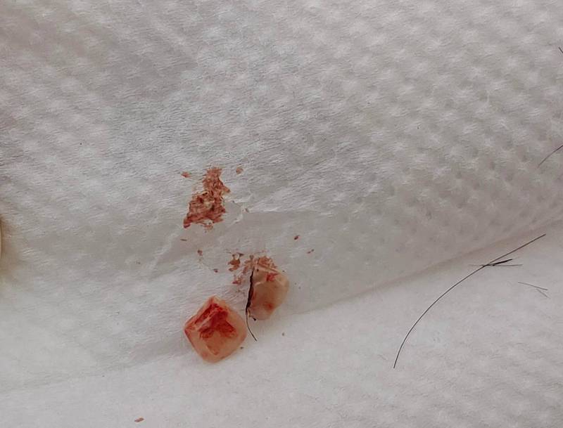 一名男子在打籃球時,頭部不小心撞斷友人門牙,6天後飄出腐臭味,嚇得就醫才被發現頭部卡門牙。(翻攝自微博)