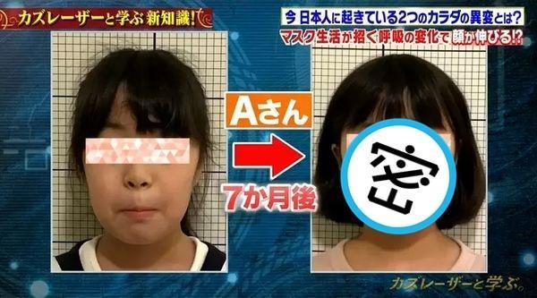 日本牙醫師山口和警告戴口罩若習慣使用嘴巴呼吸，恐會導致臉部形狀和牙齒排列出現變化。（翻攝自推特）
