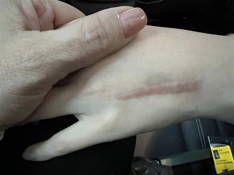 王彩樺女兒手上的疤痕還相當清晰。（翻攝自王彩樺臉書）