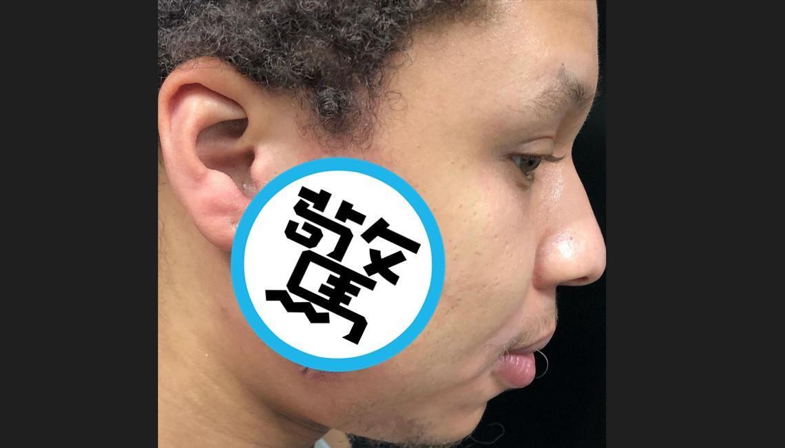 美國一名26歲男子不顧刺青師勸退，堅持在臉部刺上逼真的陰道刺青。（翻攝IG@mikey5thousand）