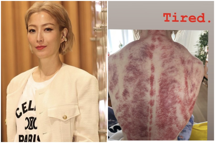 鄭秀文秀出刮痧後的超驚悚血痕，連脊椎都是一條「血柱」。（翻攝自鄭秀文IG）