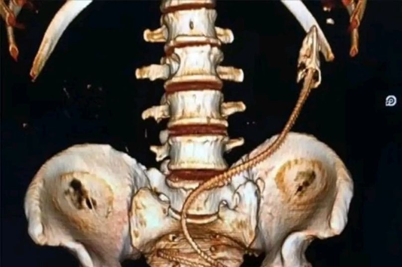 驚！男拿活鰻魚插肛門治便祕，牠鑽到「突破結腸」消化道穿孔太恐怖。（翻自臉書）