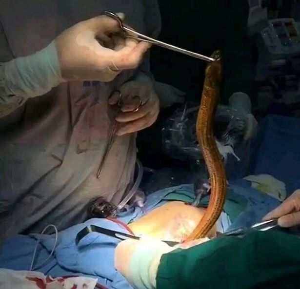 男子相信偏方，「鰻魚插肛」治便祕結果悲劇了。（翻自《每日星報》）
