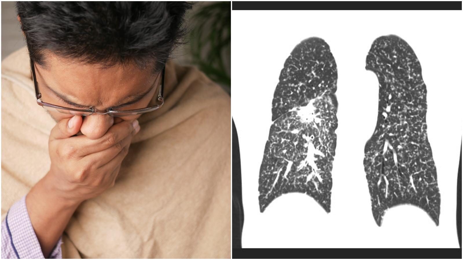 蘇一峰強調，有家族遺傳史有特別注意，否則當發現時可能就來不及；左為示意圖，非當事人。（pexels／攝影師：Towfiqu barbhuiya、翻攝自蘇一峰臉書）