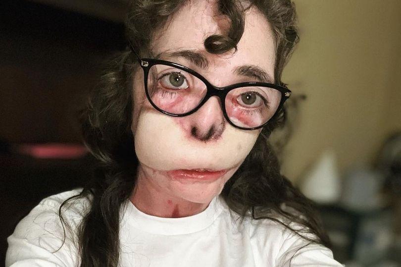 慎入!正妹的臉被大狗狠咬800下全爛,歷經18次手術「救臉」不向命運服輸。(翻自《每日星報》)