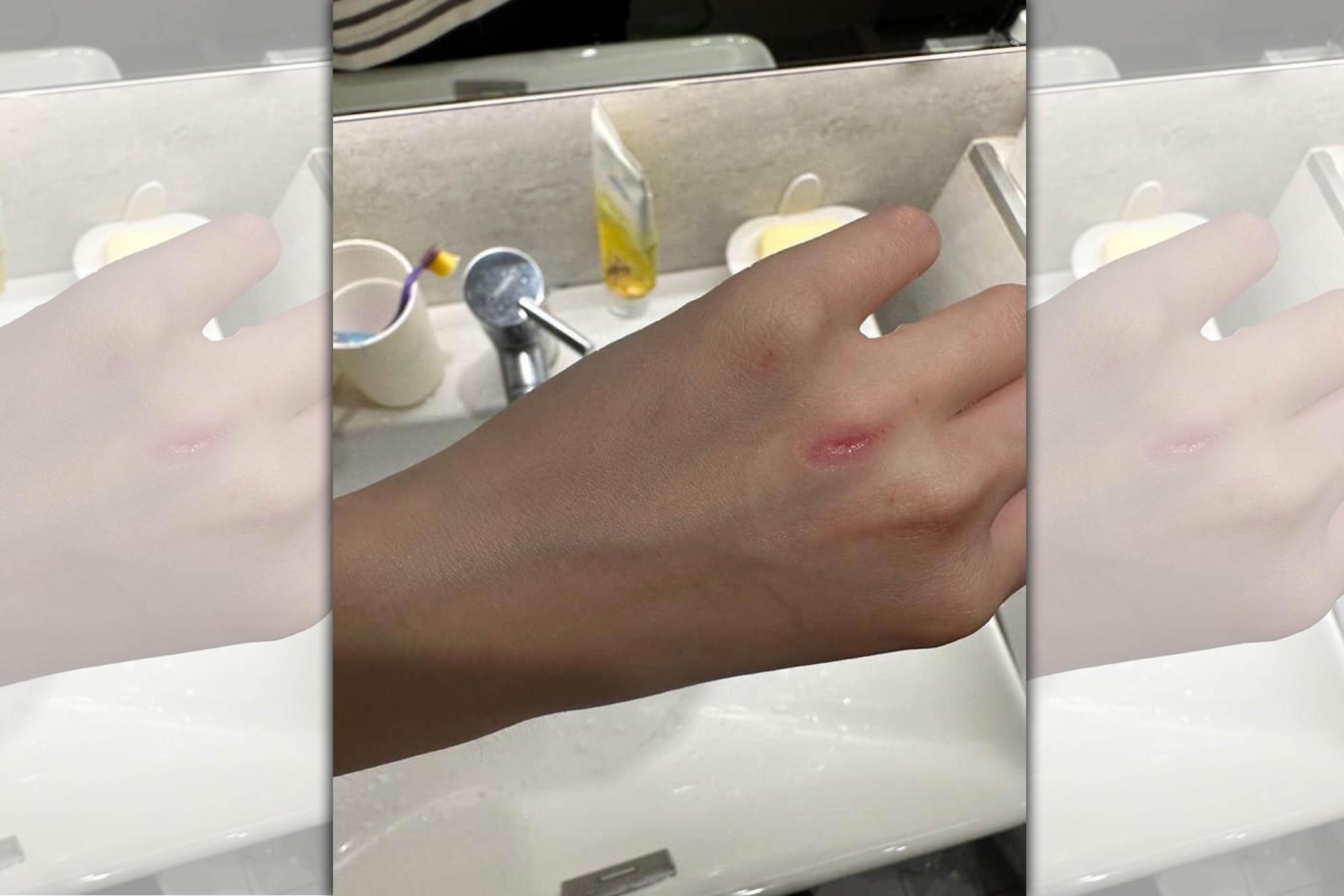 一名黃姓女律師日前赴中和某美容診所做私密處除毛，遭美容師用刀削掉手上一塊肉。（翻攝爆料公社）