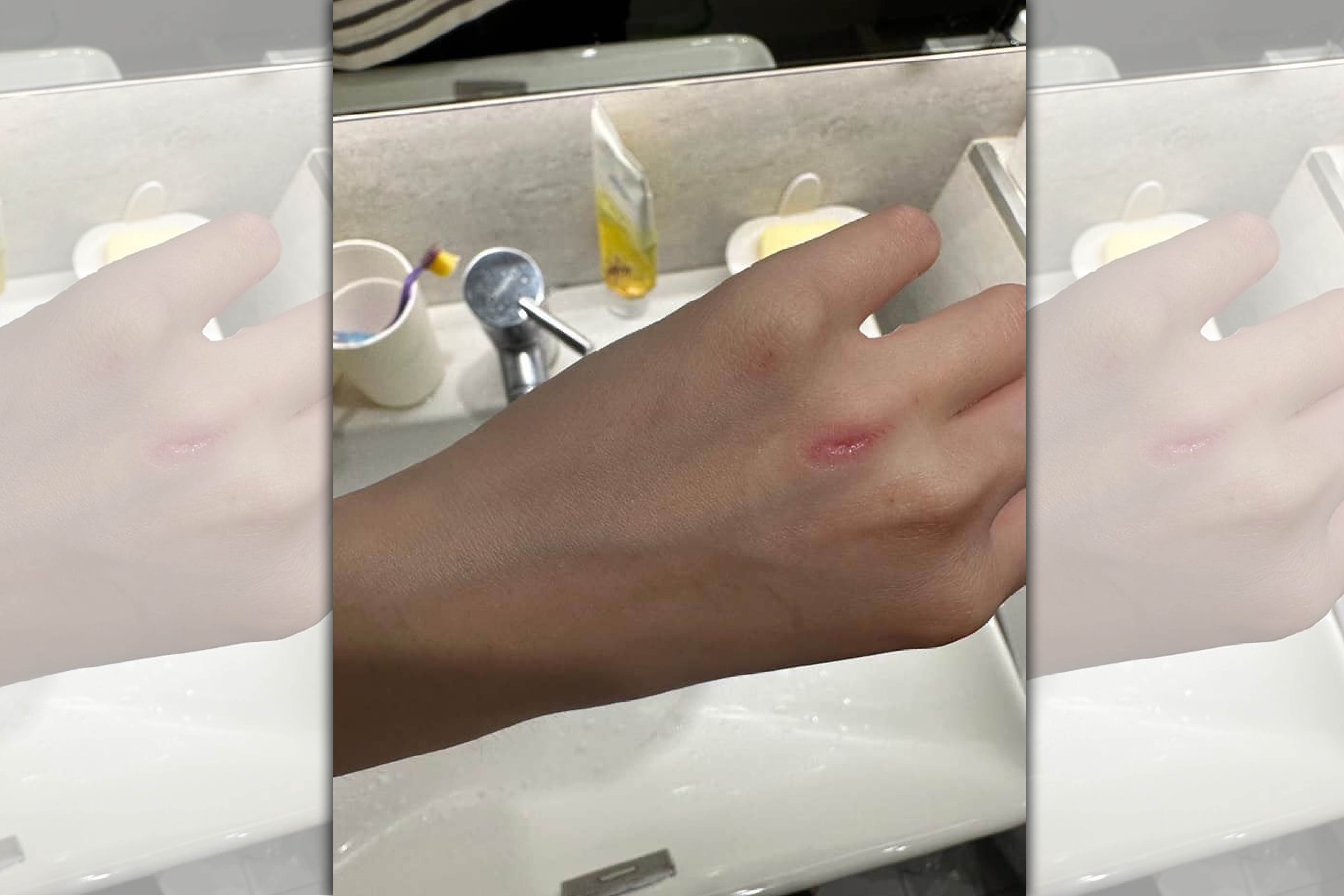 一名黃姓女律師日前赴中和某美容診所做私密處除毛，遭美容師用刀削掉手上一塊肉。（翻攝爆料公社）