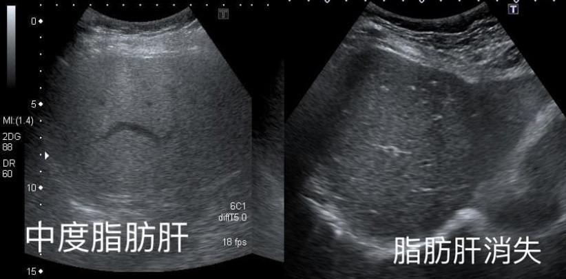婦人在1年之內解決中度脂肪肝問題,連醫師都感到驚訝。(翻攝臉書粉專「錢政弘 胃腸肝膽科醫師」)