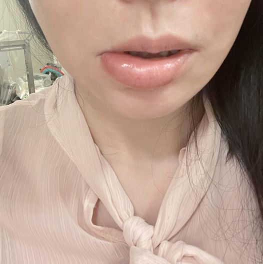 德馨po出嘴腫成香腸的畫面有些驚悚。(翻攝自臉書)
