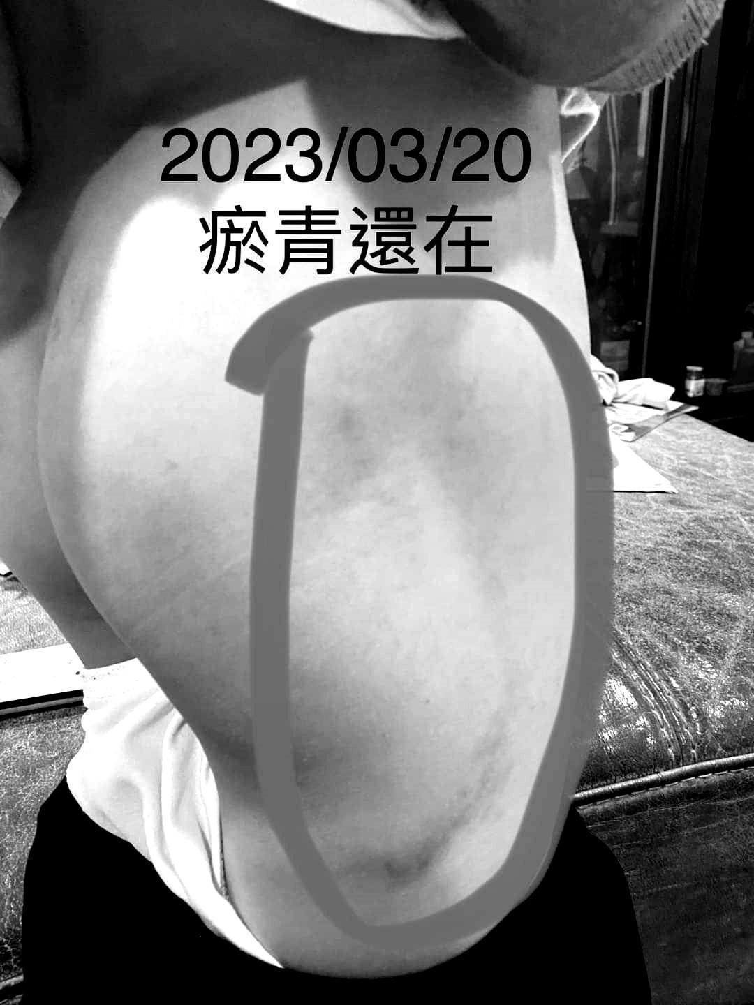 瘀青痕跡過了兩週仍未完全消退。(翻攝自新竹人有事嗎臉書社團)