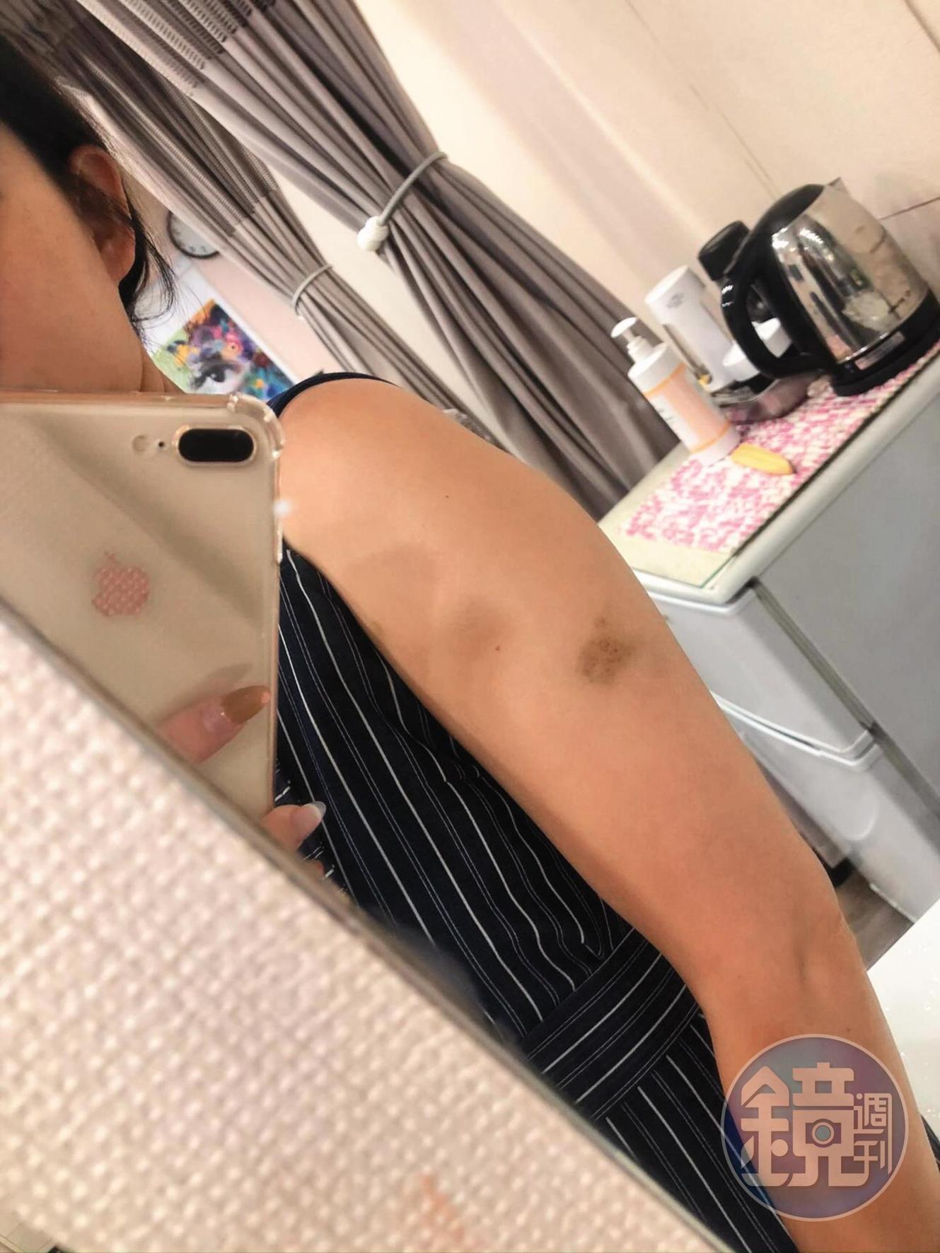 呂杰陽曾用板凳毆打前女友,致使女方手臂上滿是瘀青。(讀者提供)