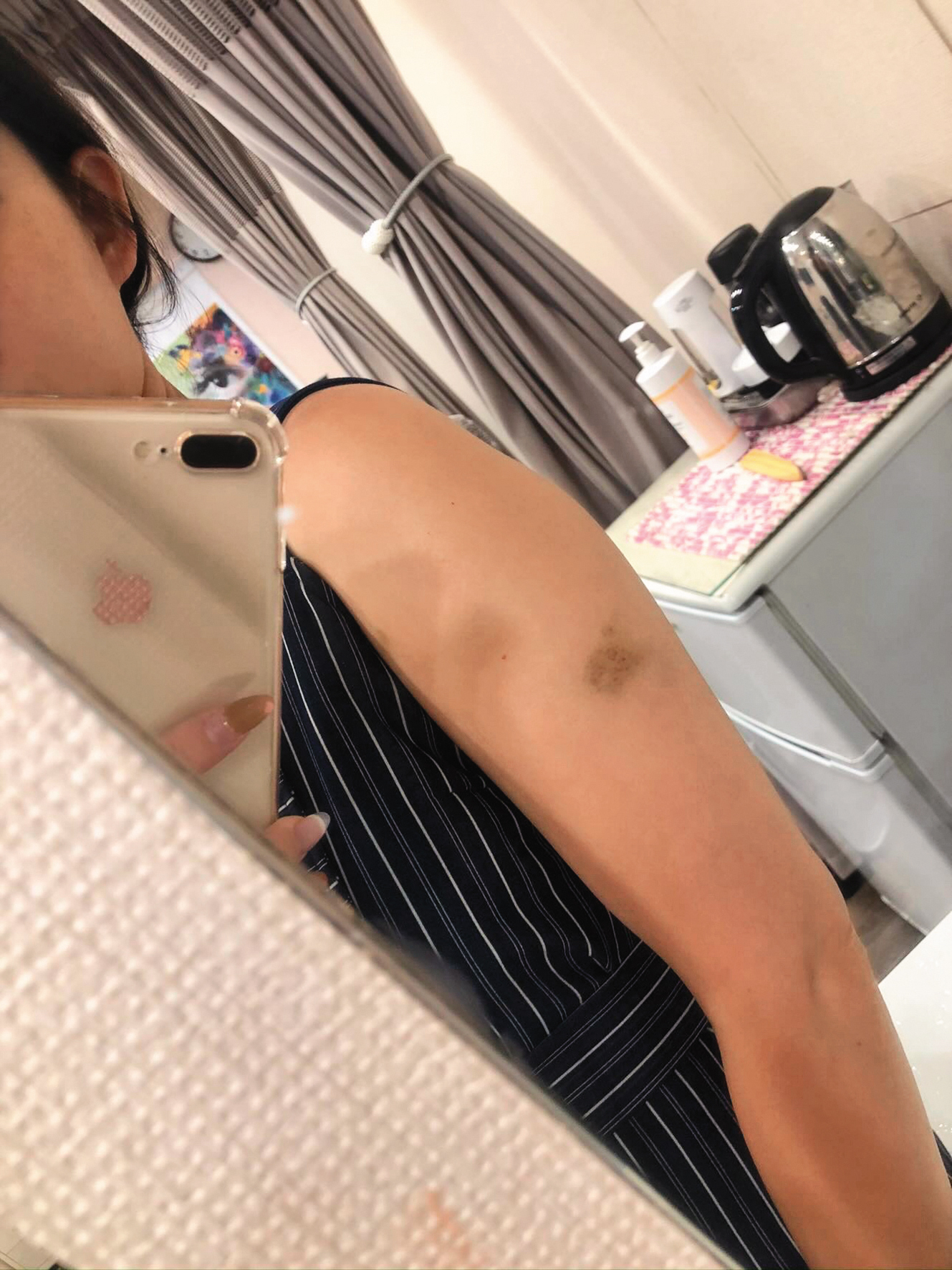 呂杰陽曾用板凳毆打前女友,致使女方手臂上滿是瘀青。(讀者提供)