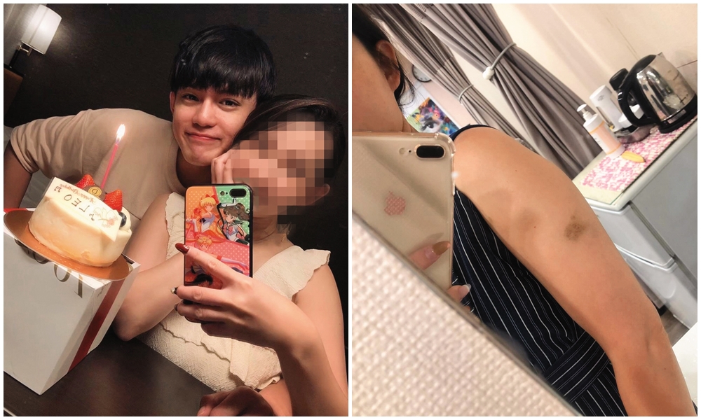 呂杰陽曾用板凳毆打前女友，致使女方手臂上滿是瘀青。（讀者提供）
