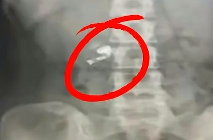 中國山東有一名男子，睡前戴著耳機入睡，怎料隔天睡醒發現耳機吞進肚子裡。（翻攝自後浪視頻）