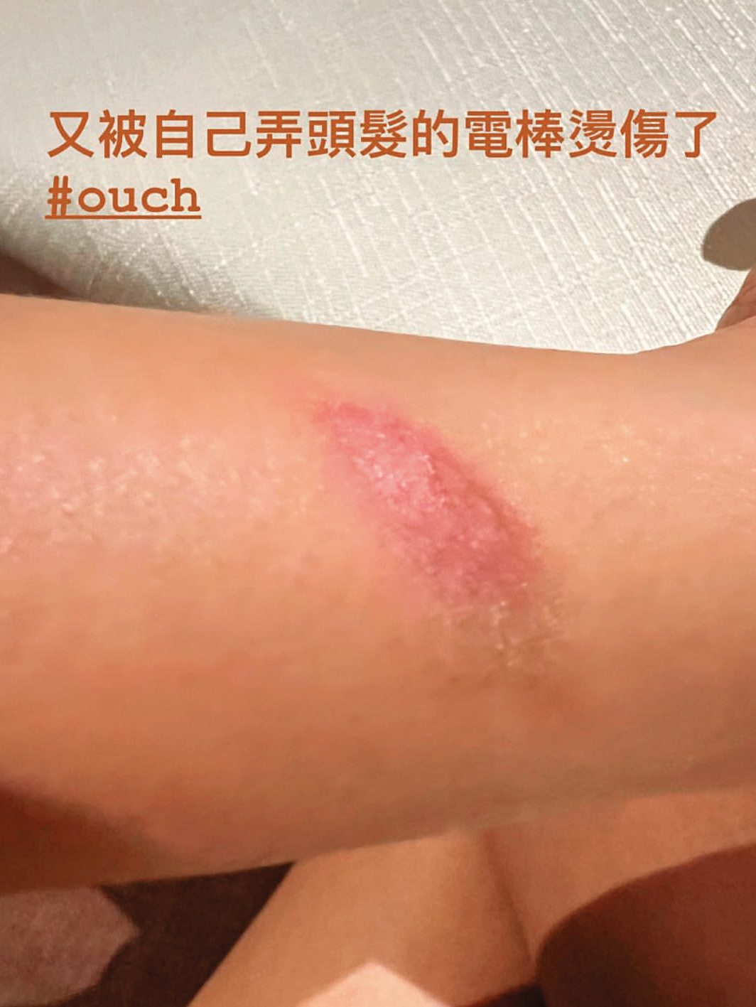 侯佩岑不小心被電捲棒燙傷，這照片怎麼有味道？（滋滋滋烤肉香）（母湯）（翻攝自侯佩岑IG）