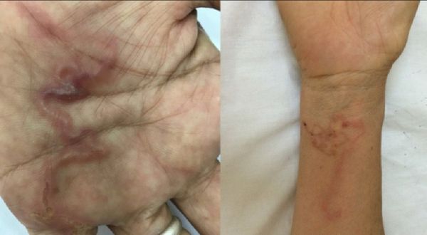 寄生蟲除了在婦女腦部築巢，皮膚底下也有肉眼可見的寄生蟲。（翻攝自越南青年報））