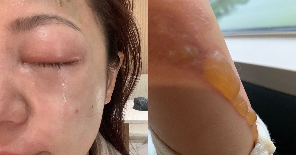 丁噹燙傷了左手起了大水泡，左臉也遭殃，事發當下甚至連左眼都無法睜開。（相信音樂提供）