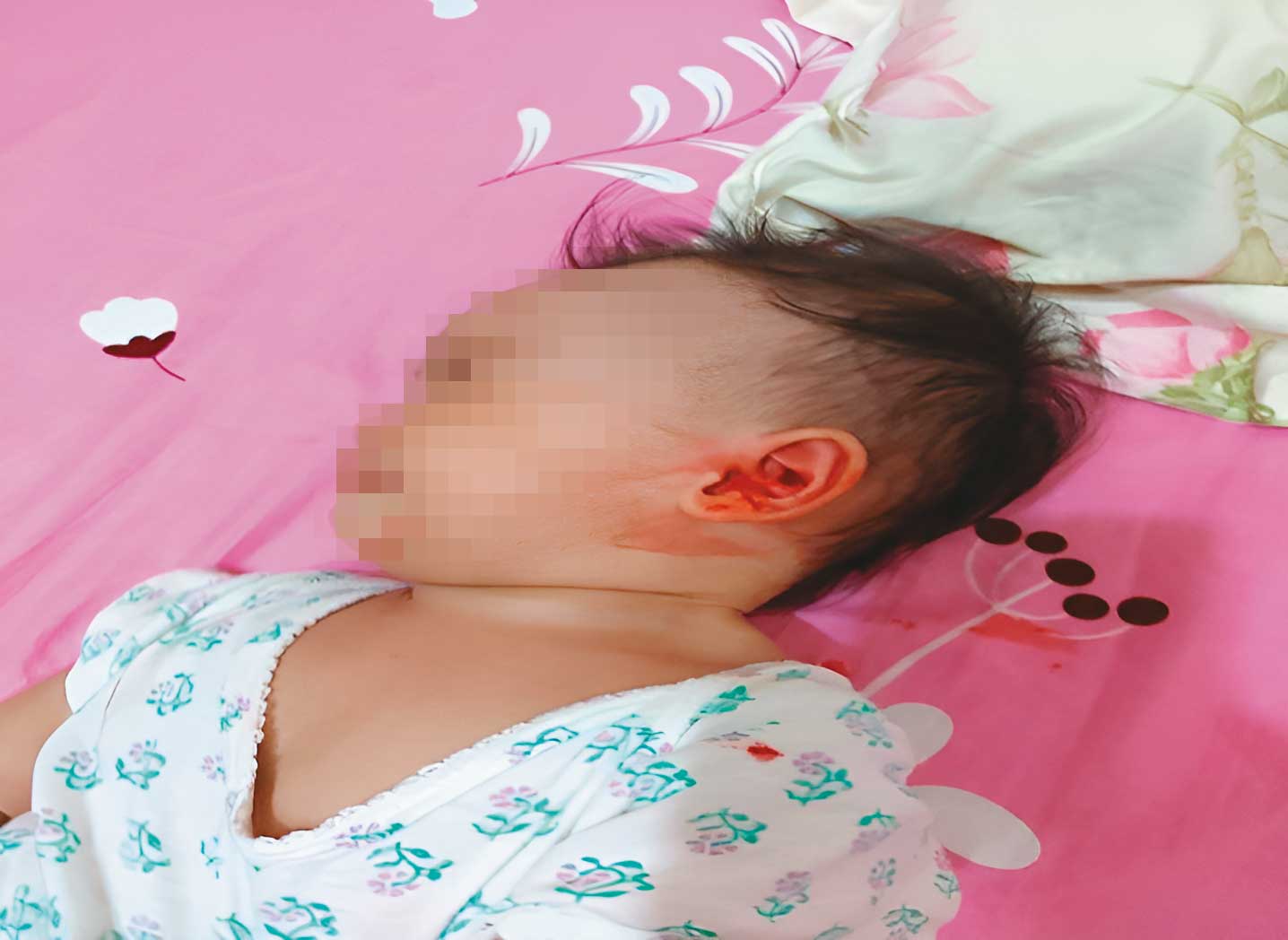 陳家1歲孫女被鄰居改建吵到噪動,抓傷自己的臉及耳朵致流血。(讀者提供)