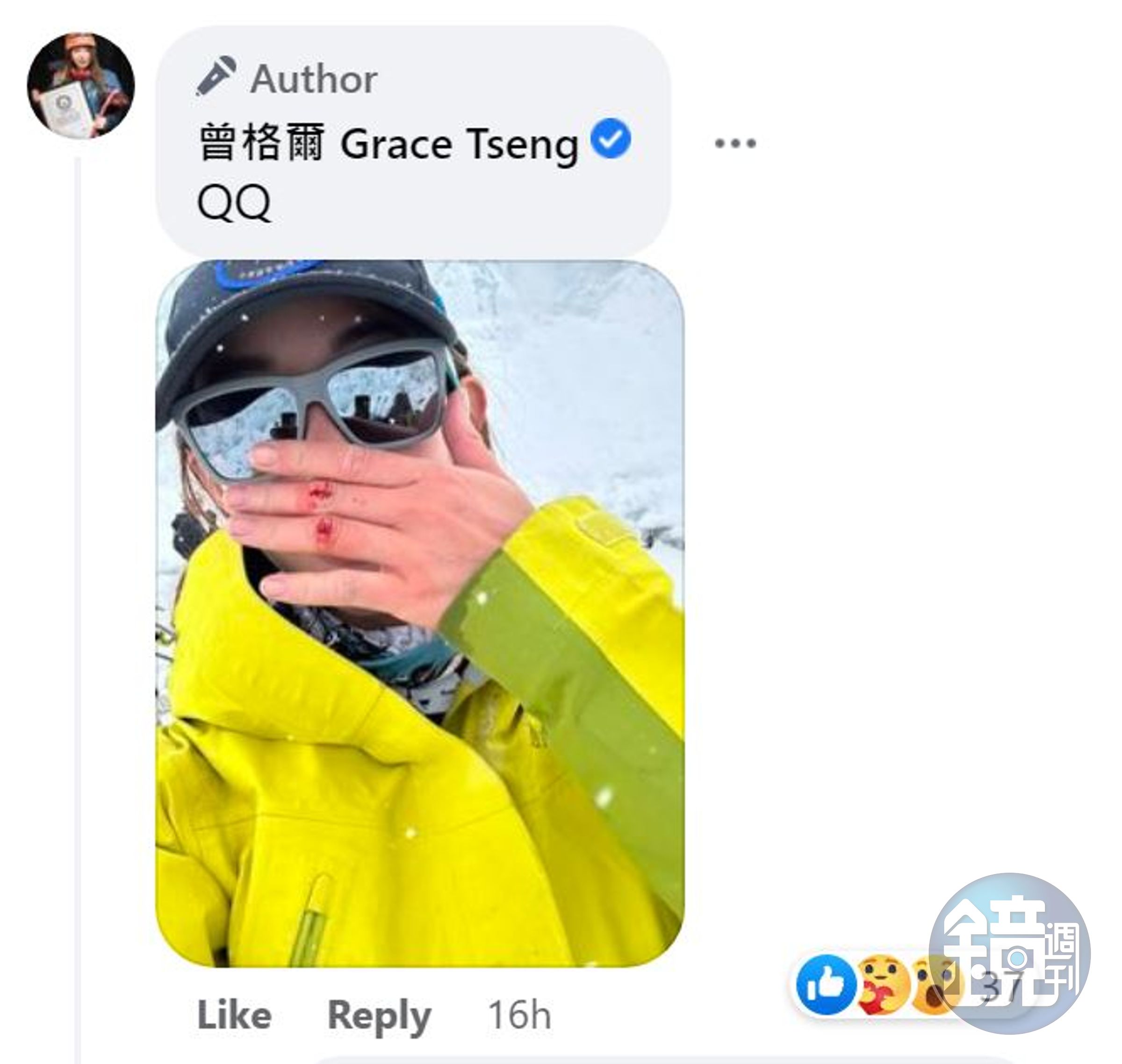 曾格爾貼出受傷照,喊QQ。(翻攝曾格爾臉書)