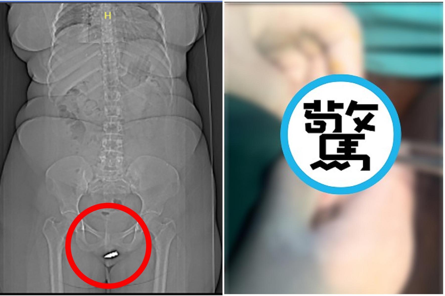 女坐客廳也中槍！下體真的被射中出事，流彈穿透天花板飛一會兒「直入洞穴」。（翻自《國際外科病例報告期刊》）
