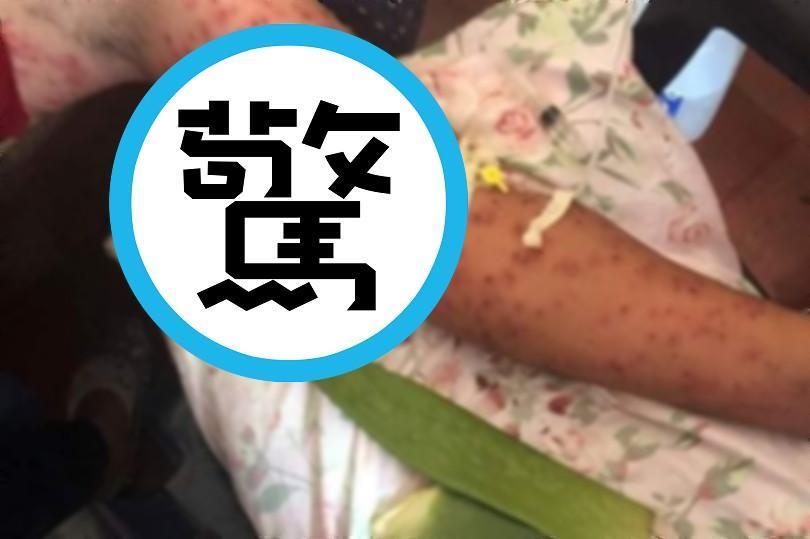 4人搭巴士墜谷活了下來,卻被殺人蜂活活螫死!身體「千瘡百孔」恐怖影像曝光。(翻自《每日星報》)