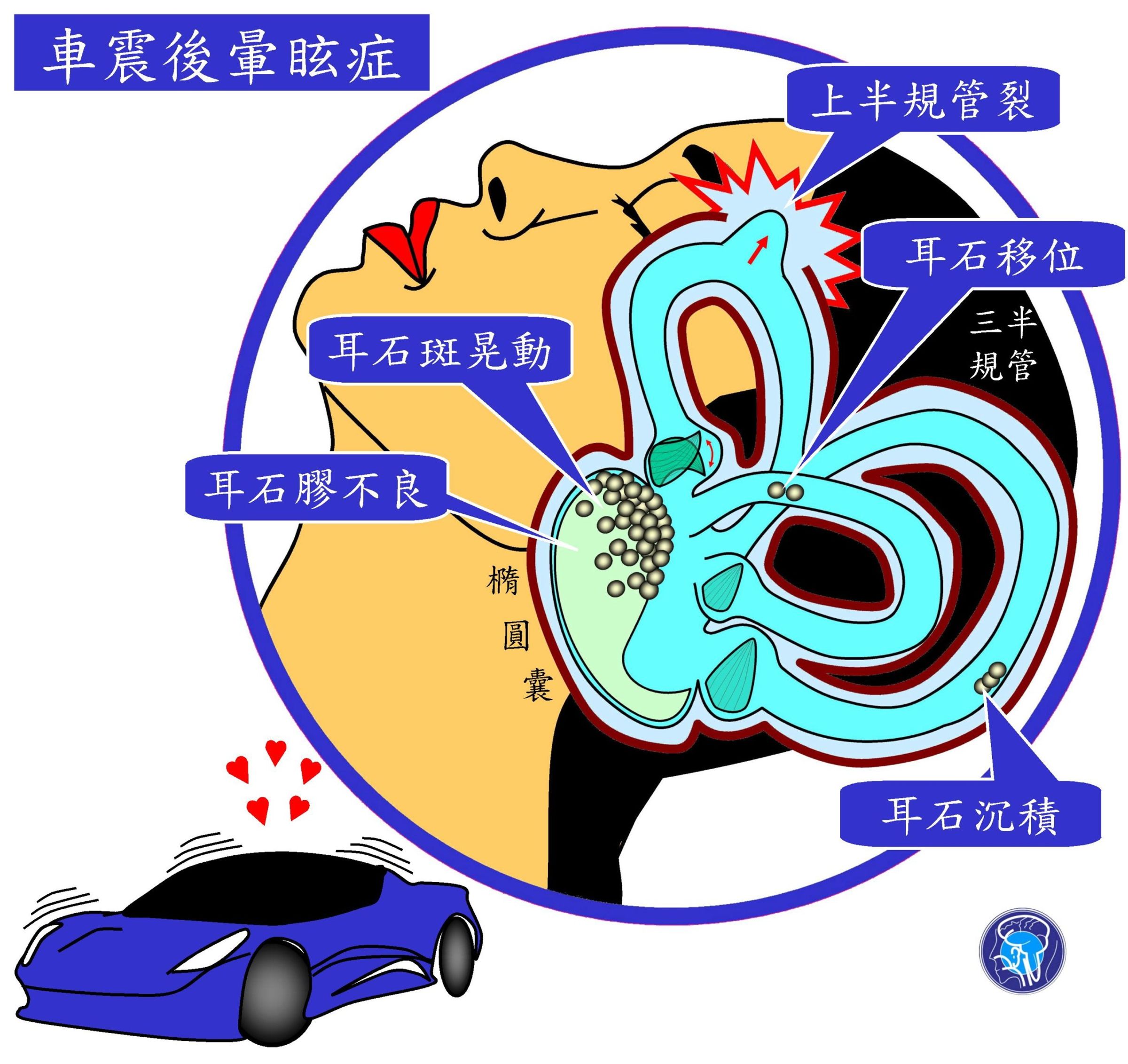 陳建志醫師說明內耳橢圓囊位置。